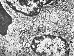 F,47y. | spleen - hairy cell leukemia